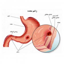 زخم معده چیست و چگونه می توان آن را کنترل کرد